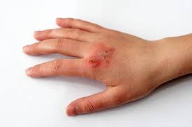 Injury on hand